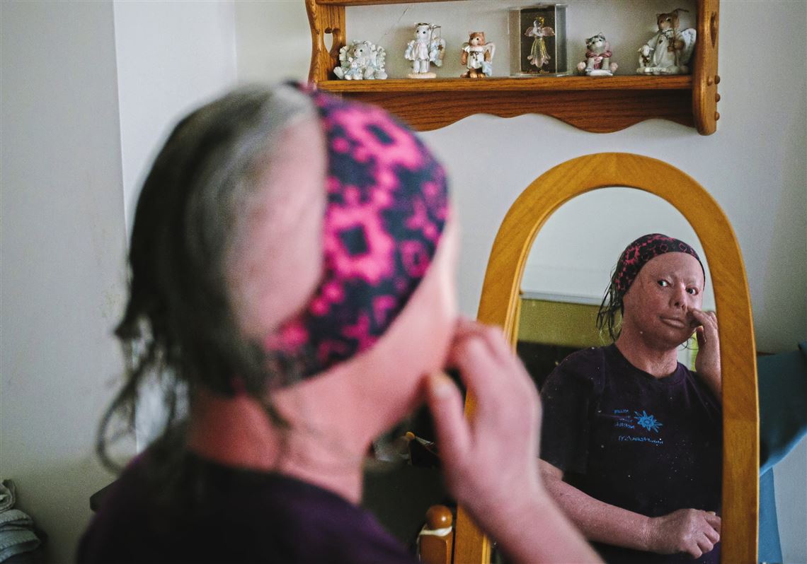 Stare, but please don't look away, says Pittsburgh woman with rare skin