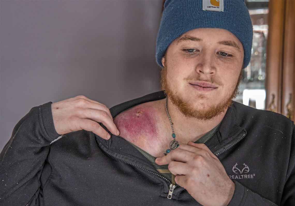 Mitchell Barton, 21, shows scarring from a large Ewing sarcoma tumor on his shoulder on Wednesday, Jan. 22, 2019, at his home in North Strabane. Six cases of Ewing sarcoma have occurred within the Canon-McMillan School District boundaries since 2008, including two cases diagnosed in the past nine months. 