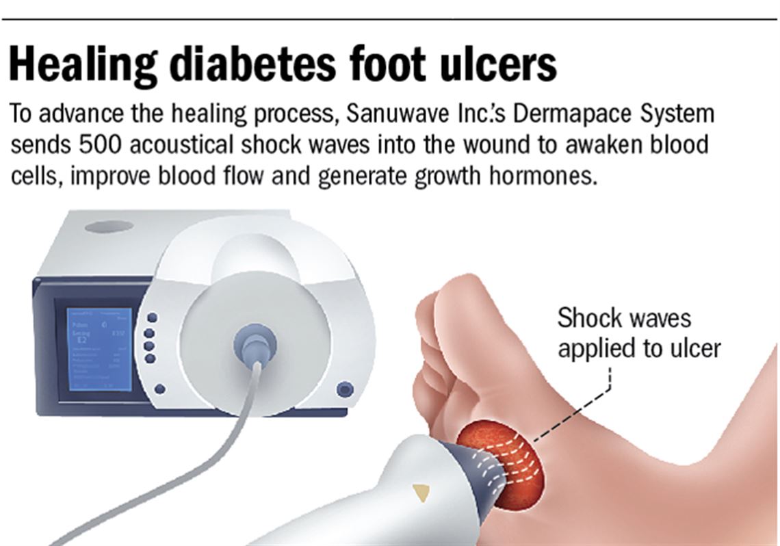 healing foot ulcer