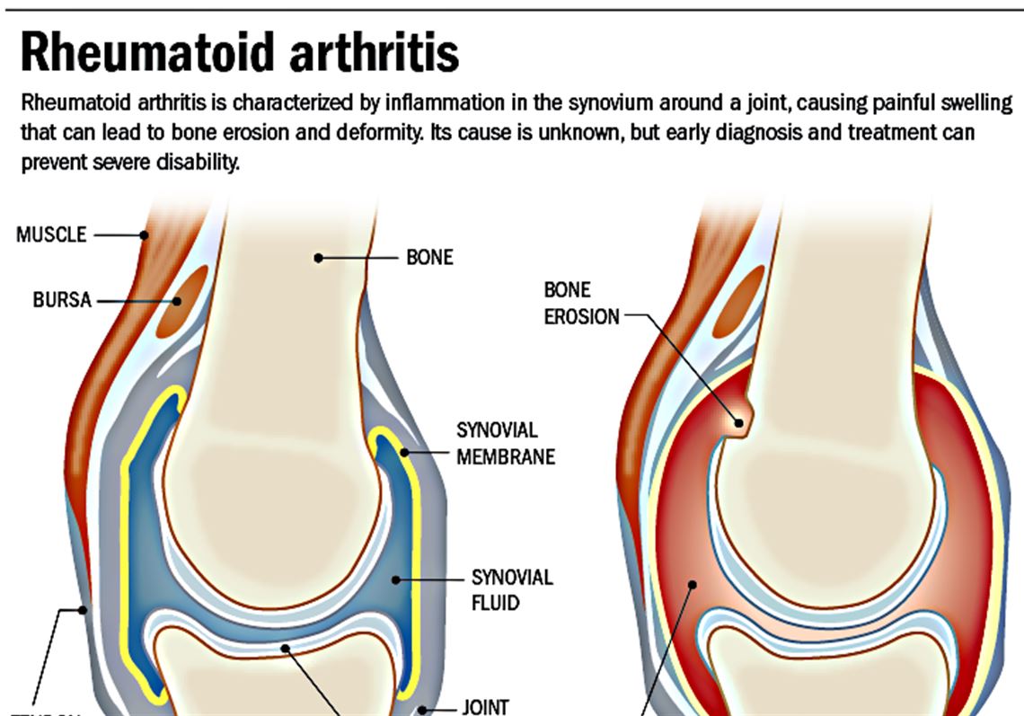 Rheumatoid arthritis A boka fertőző ízületi gyulladása