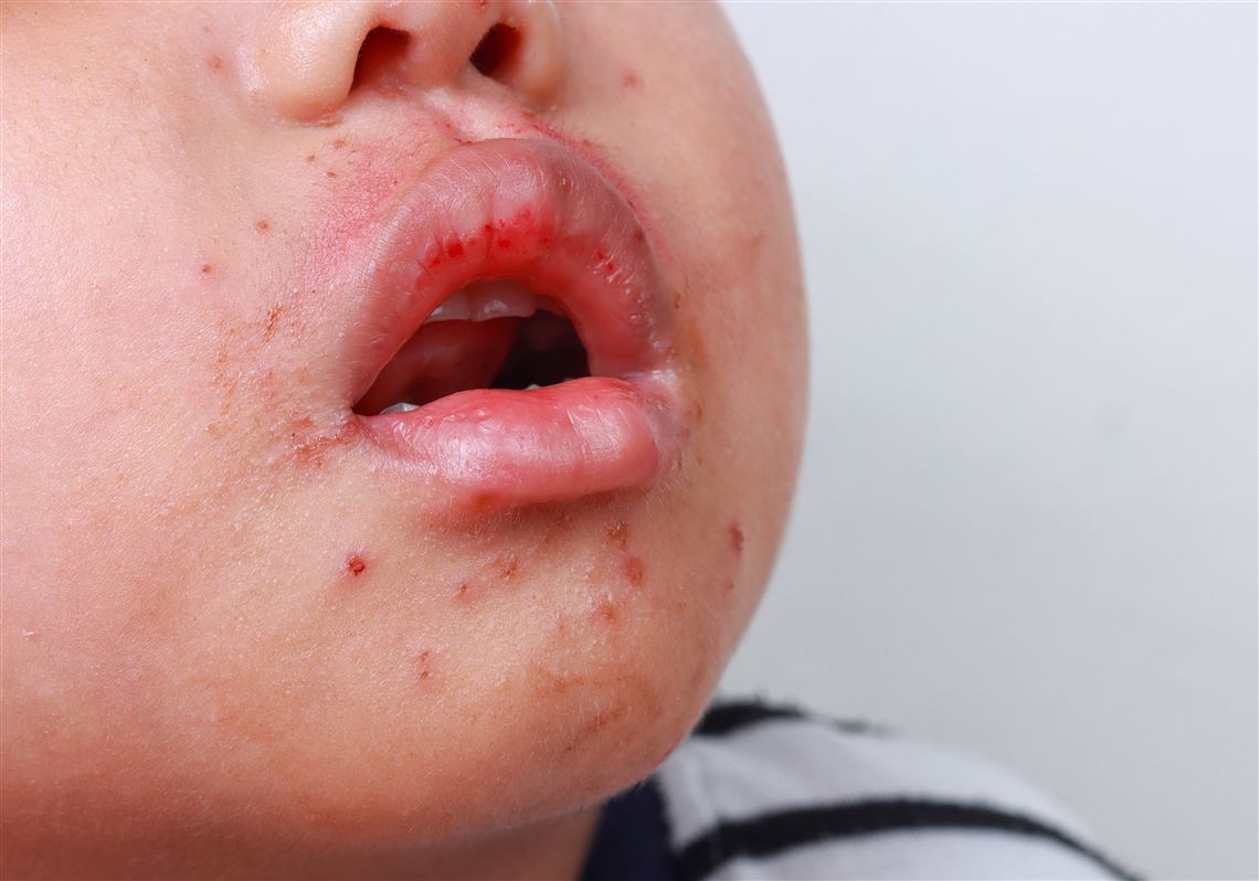 hand foot and mouth disease in mouth